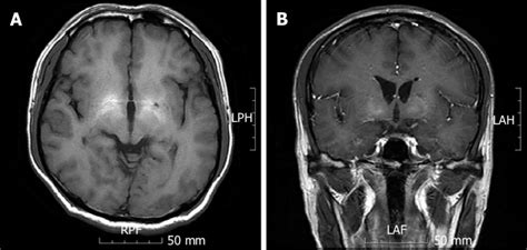 magnetic resonance imaging results